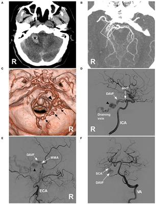 Case report: Onyx embolization of tentorial dural arteriovenous fistula via the meningohypophyseal trunk and medial tentorial artery of Bernasconi-Cassinari